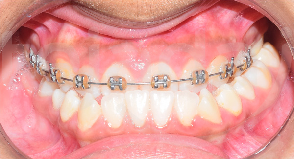 Caso Clínico ortodoncia