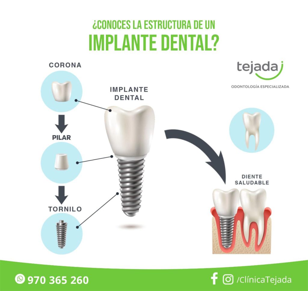 Implantes dentales en Tacna