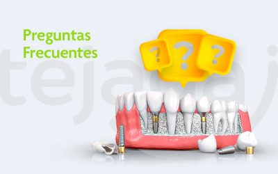 Preguntas frecuentes sobre implantes dentales: Respondiendo a tus inquietudes