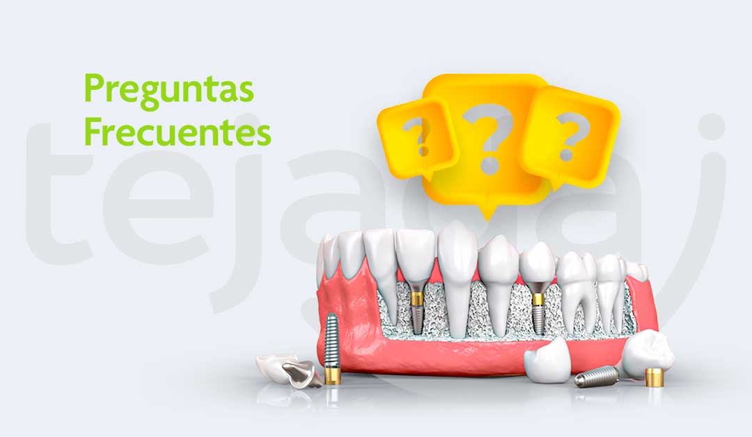 Preguntas frecuentes sobre implantes dentales: Respondiendo a tus inquietudes