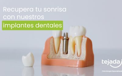 Implantes dentales: la solución definitiva a los dientes perdidos