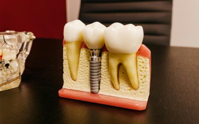 Ventajas de los implantes dentales frente a las prótesis removibles