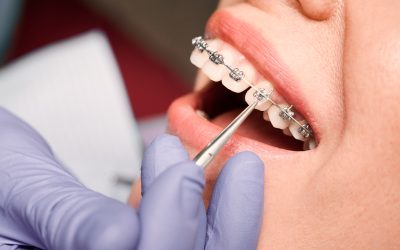 Ortodoncia: ¿Es para ti?