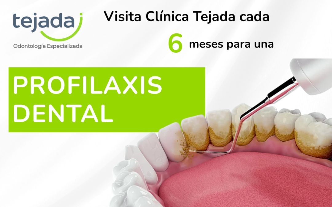 ¿Por qué es importante una limpieza dental cada 6 meses?