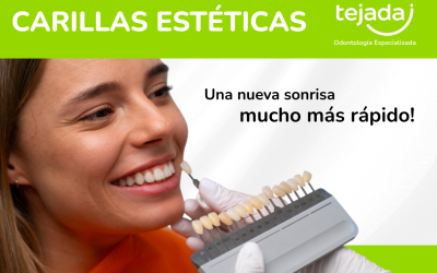Carillas Estéticas: transforma tu sonrisa en pocas sesiones