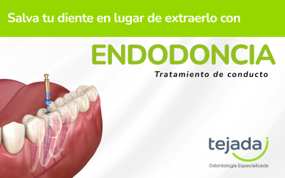 Endodoncia: cómo este tratamiento puede salvar tu diente