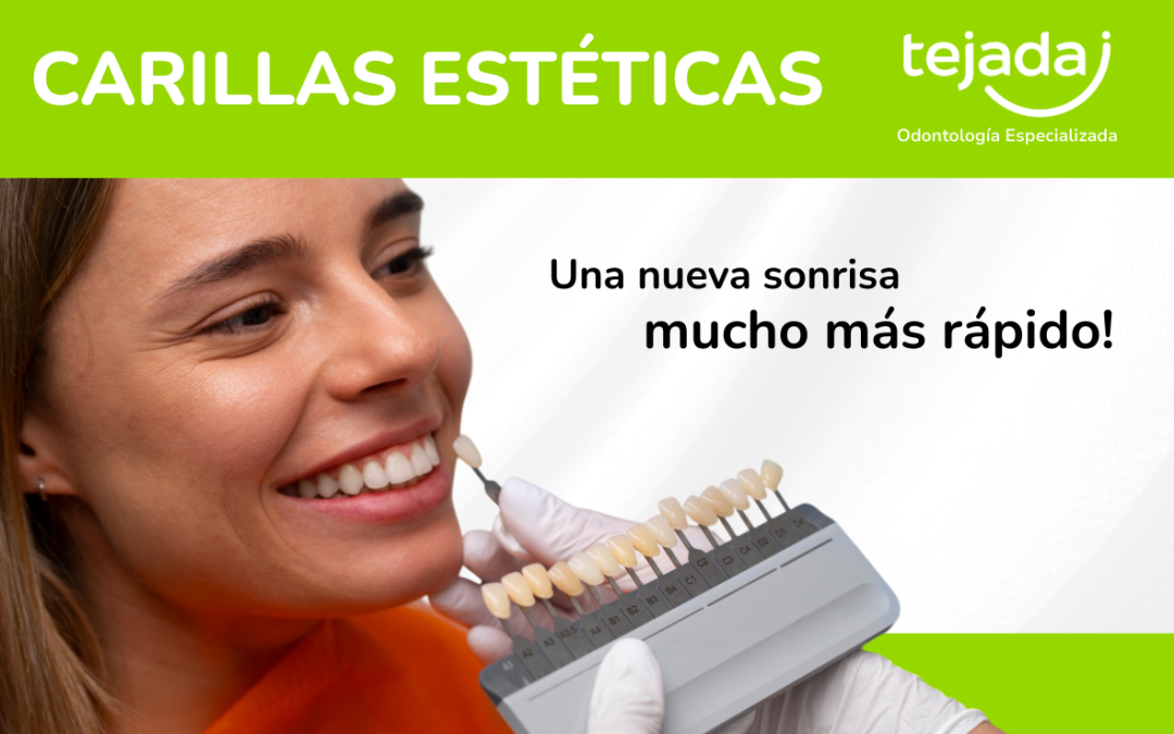 Carillas Estéticas: transforma tu sonrisa en pocas sesiones
