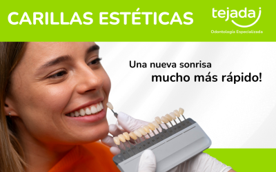 Carillas Estéticas: transforma tu sonrisa en pocas sesiones